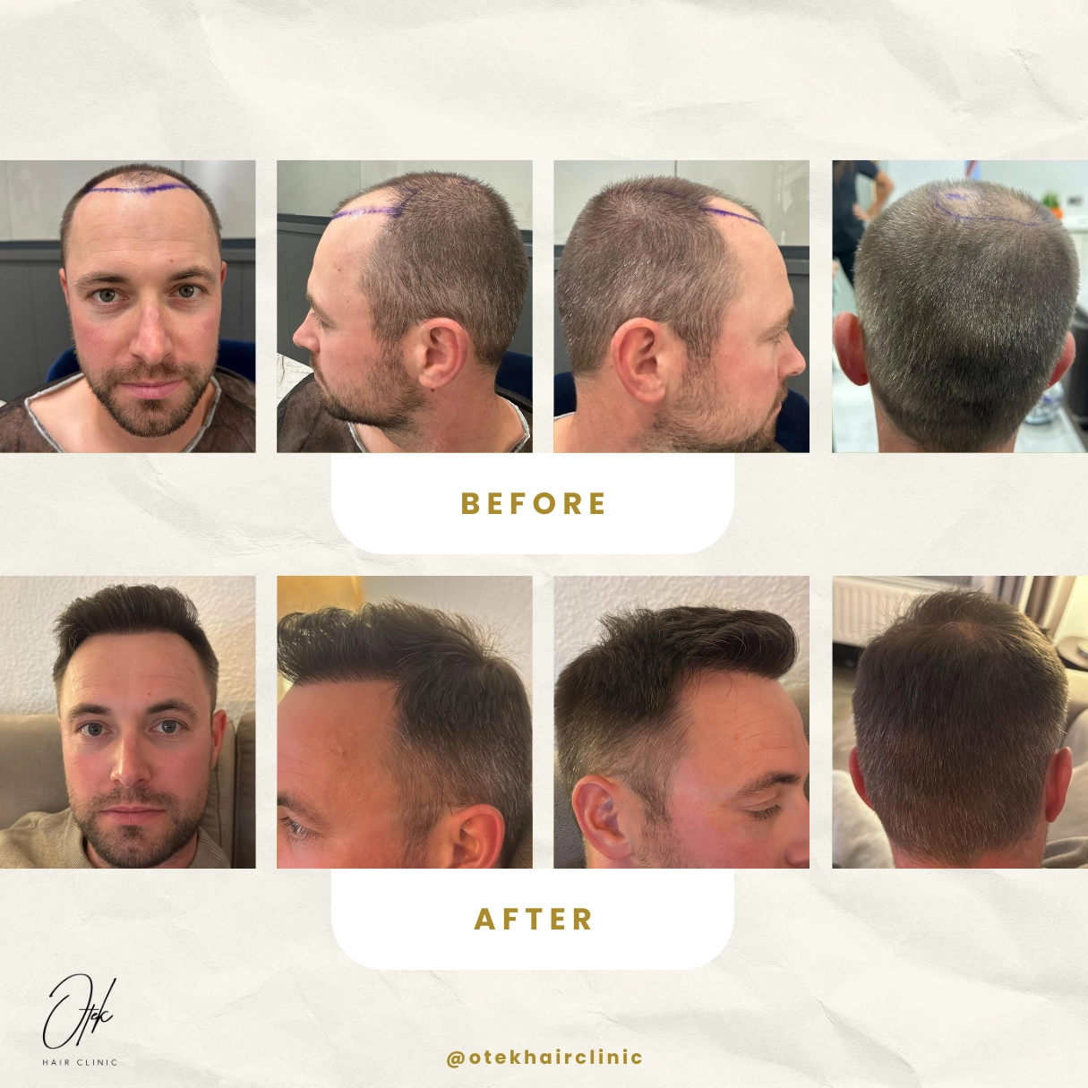 Obnova vlasovej línie - OTEK Hair Transplant