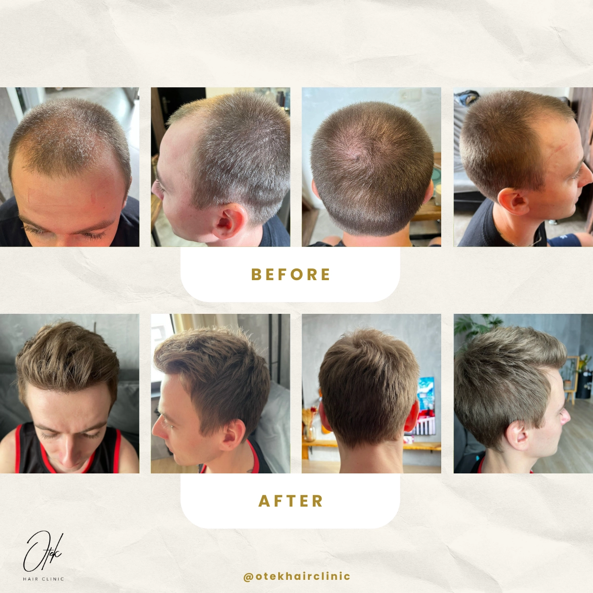 Zahustenie hornej časti - OTEK Hair Transplant