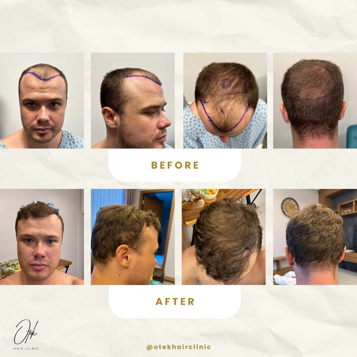 Prirodzený a hustejší účes - OTEK Hair Transplant