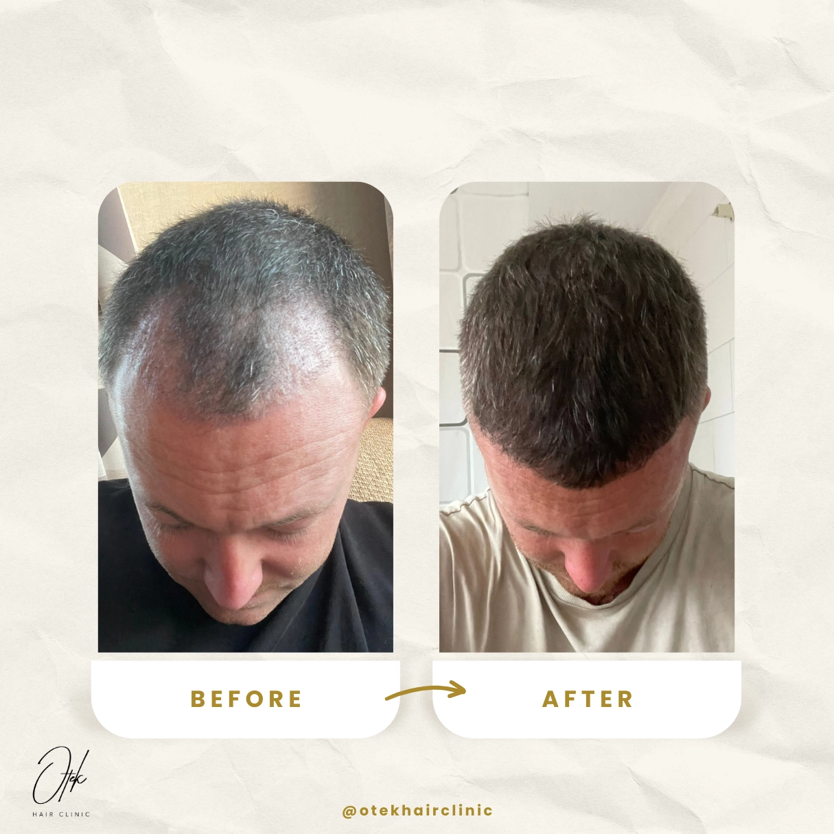 Zvýšenie hustoty vlasov - OTEK Hair Transplant