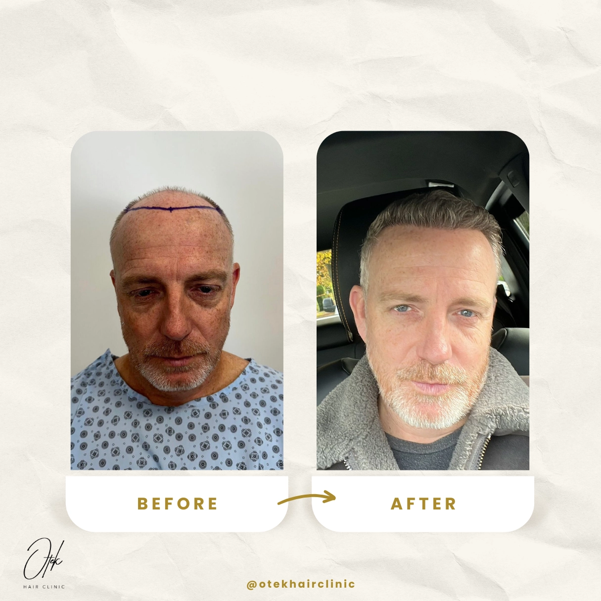 Celková premena účesu - OTEK Hair Transplant