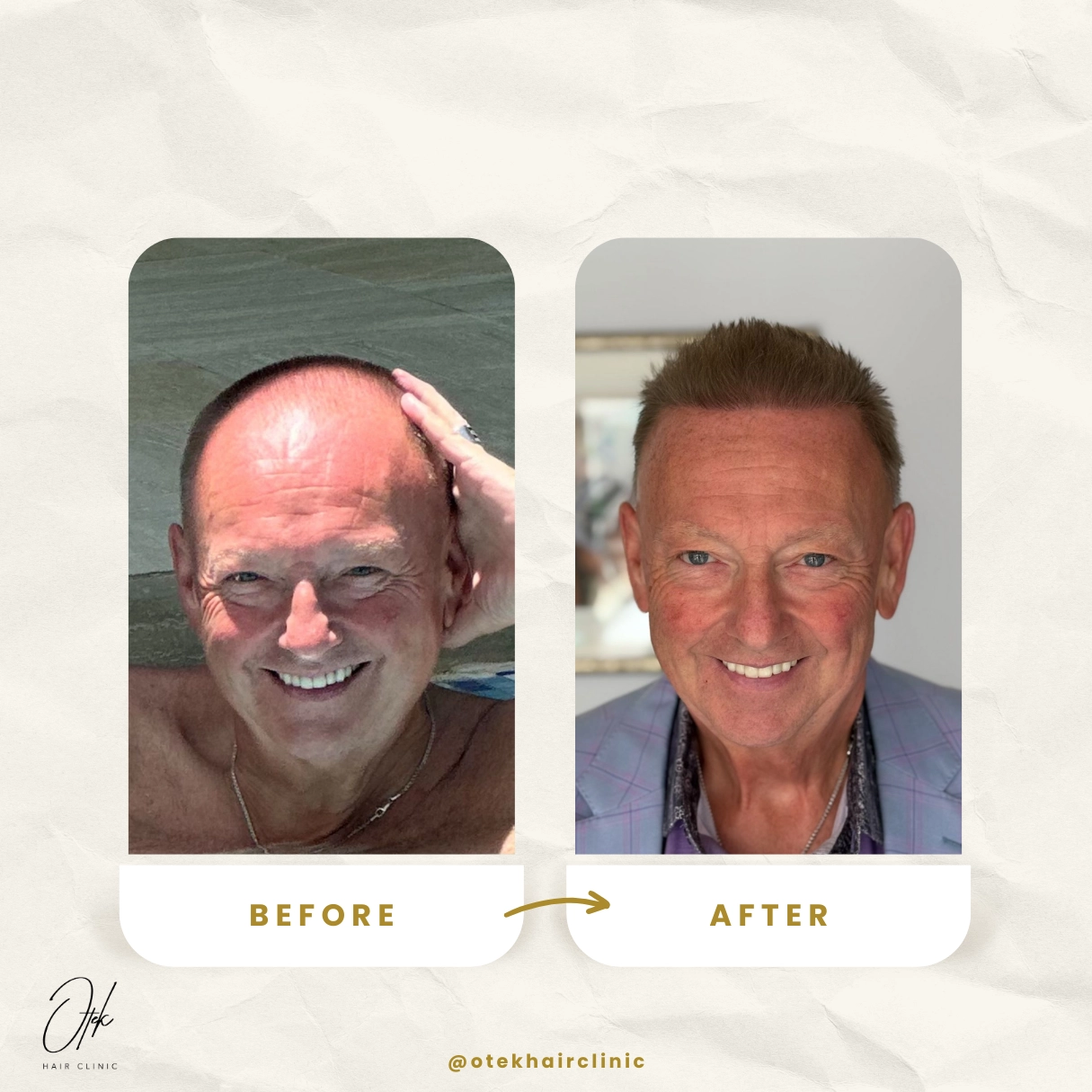 Transformácia vlasovej línie - OTEK Hair Transplant