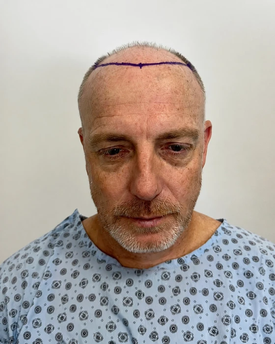 Marek, 51 rokov, pred transplantáciou vlasov FUE v OTEK Hair Clinic v Antalyi