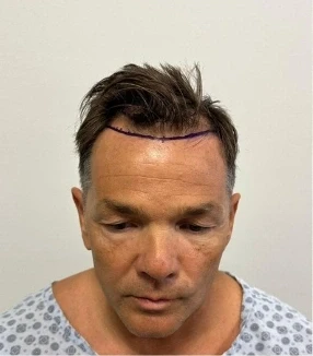 Petr, 47 rokov, pred transplantáciou vlasov DHI v OTEK Hair Clinic v Antalyi – čelný pohľad
