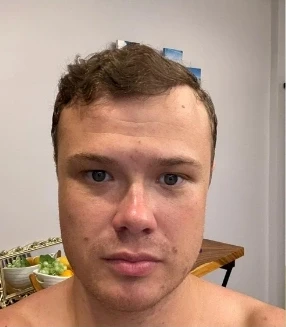 Jirka po transplantácii vlasov FUE, približne 3 500 štepov – čelný pohľad