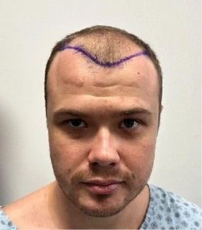 Jirka, 36 rokov, pred transplantáciou vlasov FUE v OTEK Hair Clinic v Antalyi – čelný pohľad